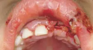 Mouth Injuries