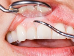 Gum Tissue Graft Surgery