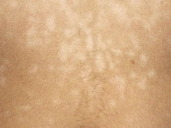 Why Most People Fail At Trying To Treat Tinea Versicolor
