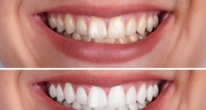 Tooth Discoloration