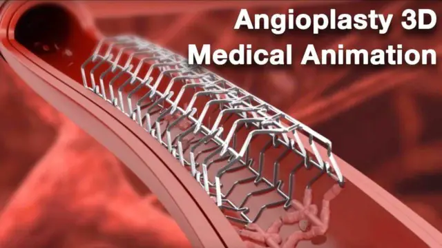 Your Quick Guide to an Angioplasty Procedure | Healthtian