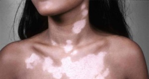 Vitiligo Treatments