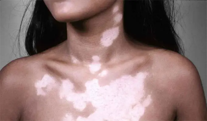 Vitiligo Treatments