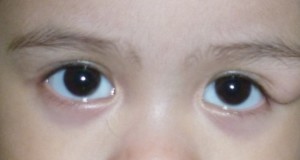 Eyelid Inflammation