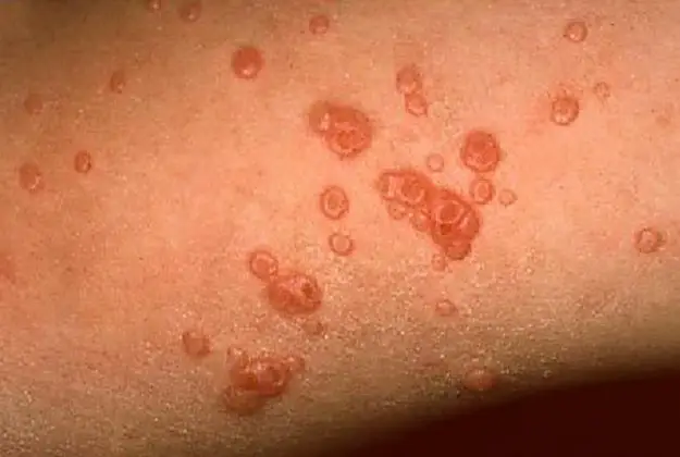 Molluscum Contagiosum Symptoms Causes Treatment And Life Cycle Healthtian 2020