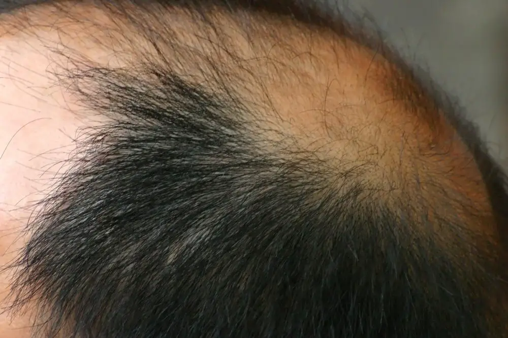 Involutional alopecia