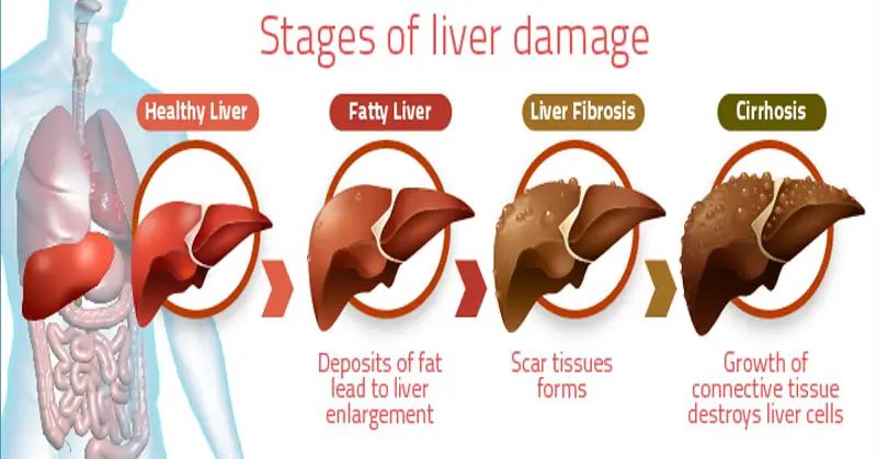 Liver Disease Treatments