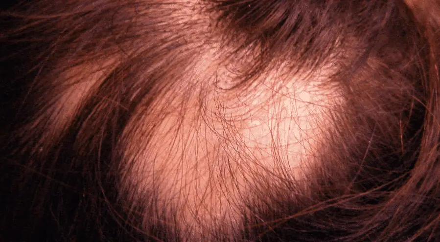 Patchy hair loss