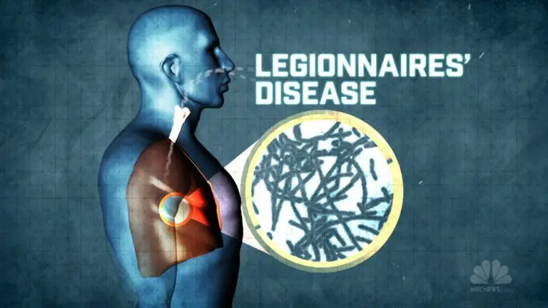 Legionnaires’ Disease: Symptoms And Causes | Healthtian