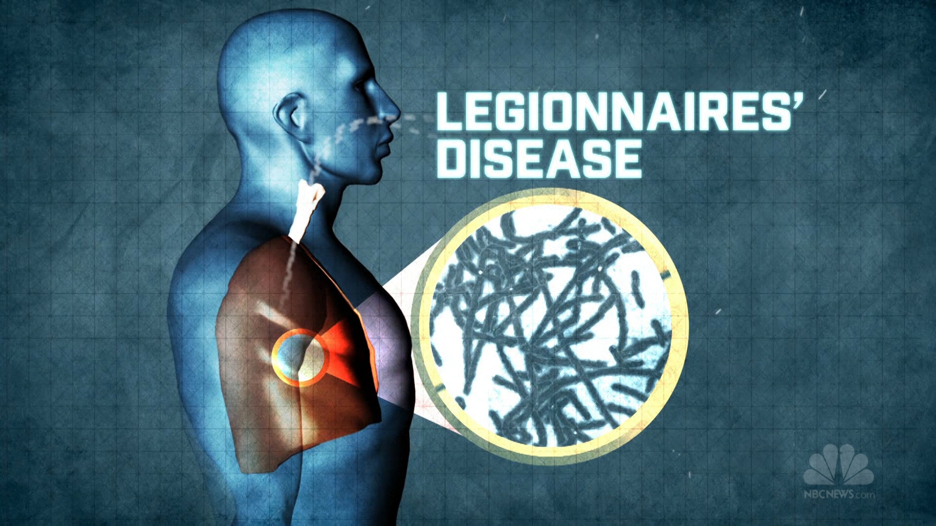 Legionnaires’ Disease: Symptoms And Causes | Healthtian