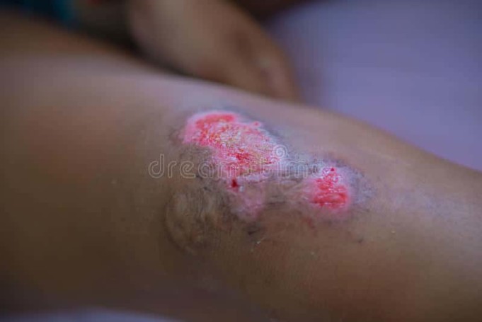 Wound Infection