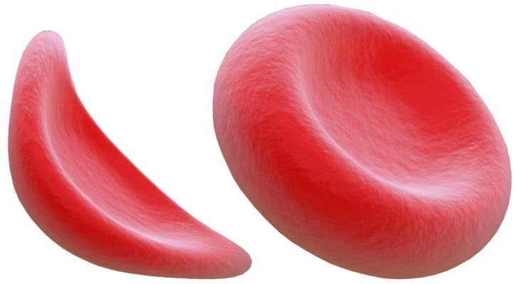 What Is Sickle Cell Anemia? Types, Symptoms and Treatment