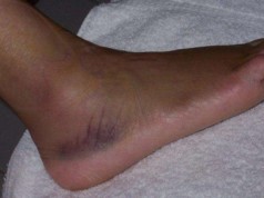 Sprained Ankle