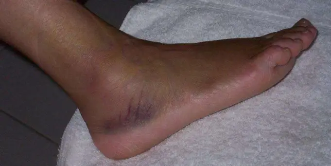 Sprained Ankle