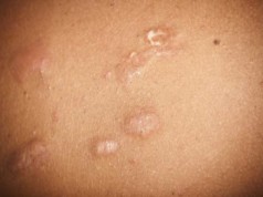 skin Scars