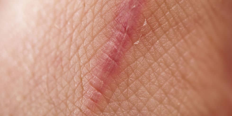 skin Scars