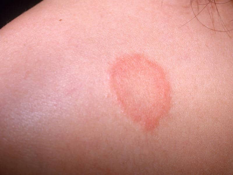 Skin Rashes Causes Symptoms And Effective Home Remedies