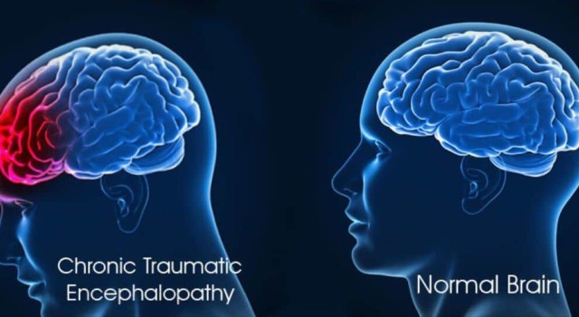 what-is-chronic-traumatic-encephalopathy-cte-healthtian