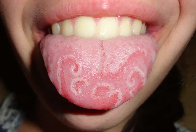 6-types-of-spots-on-the-tongue-healthtian