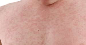 German Measles