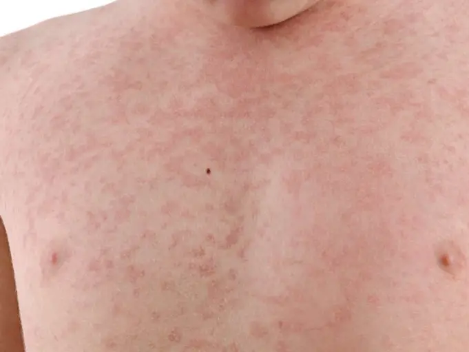German Measles