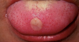Spots on the Tongue