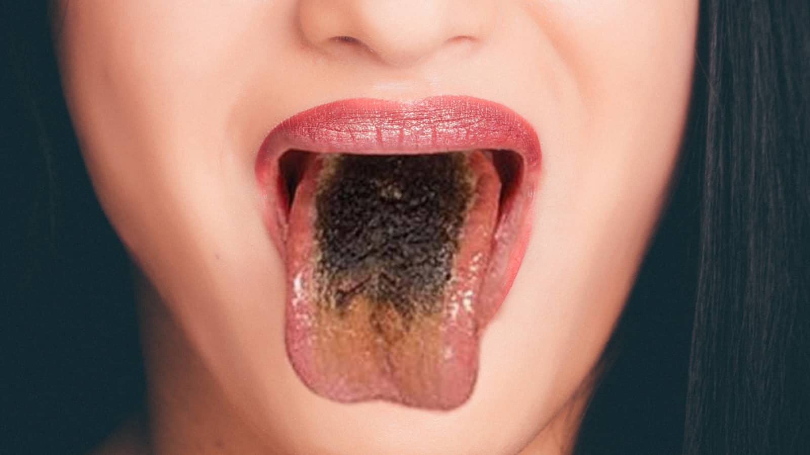 Black Hairy tongue