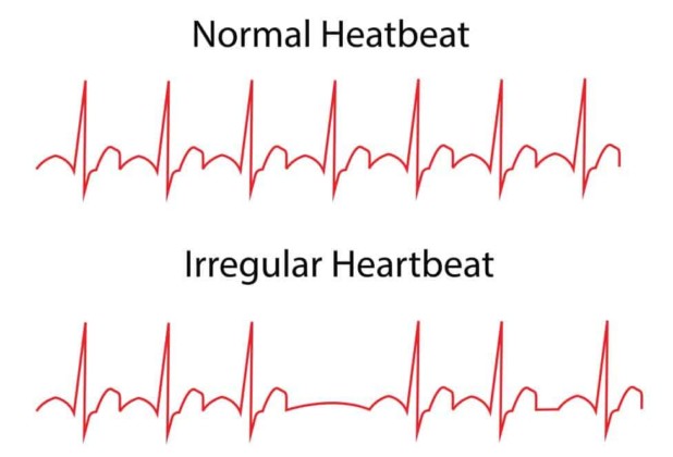 Heart Arrhythmias – Types, Causes and Prevention | Healthtian