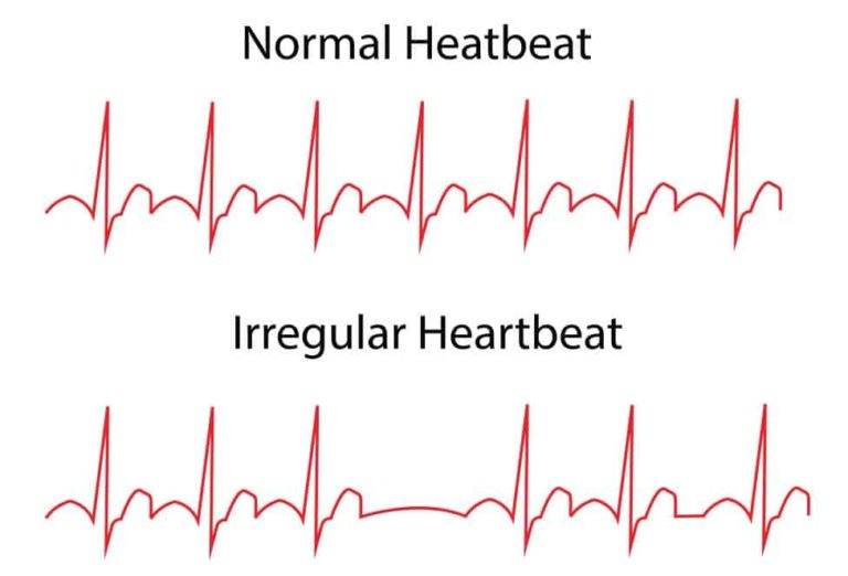 irregular-heartbeat-symptom-information-menopause-now