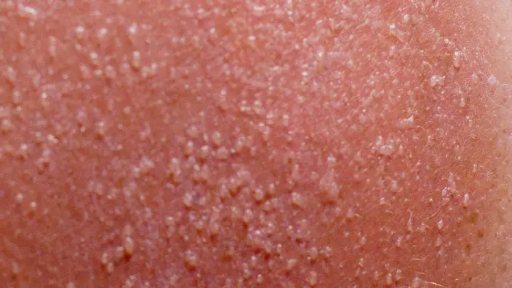 sun-poisoning-causes-symptoms-prevention-and-treatment