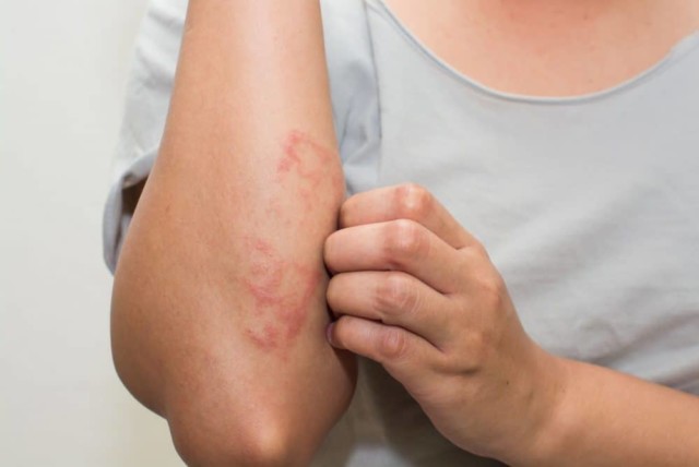 Types of Psoriasis: Causes, Symptoms, Treatment and Prevention | Healthtian