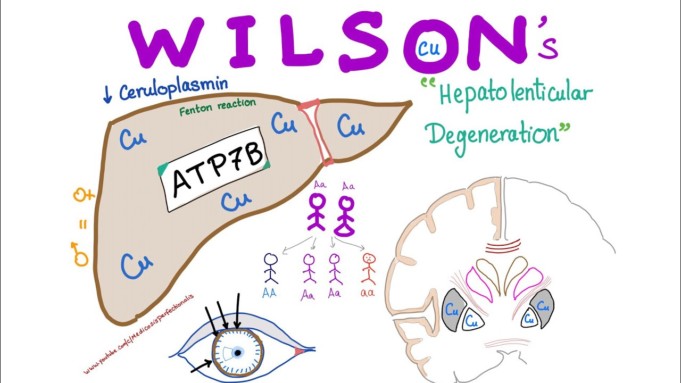 Wilson Disease