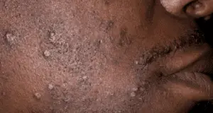 Shaving Bumps