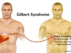 Gilbert Syndrome
