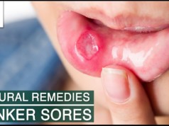 Home Remedies for Canker Sores