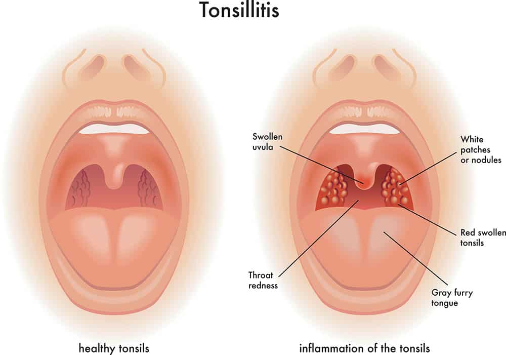 Powerful Home Remedies For Tonsillitis