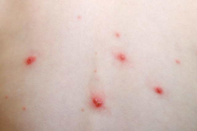 Chickenpox – Causes, Sysmptoms, Stages and Treatment | Healthtian