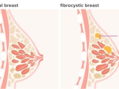 Fibrocystic Breast Disease
