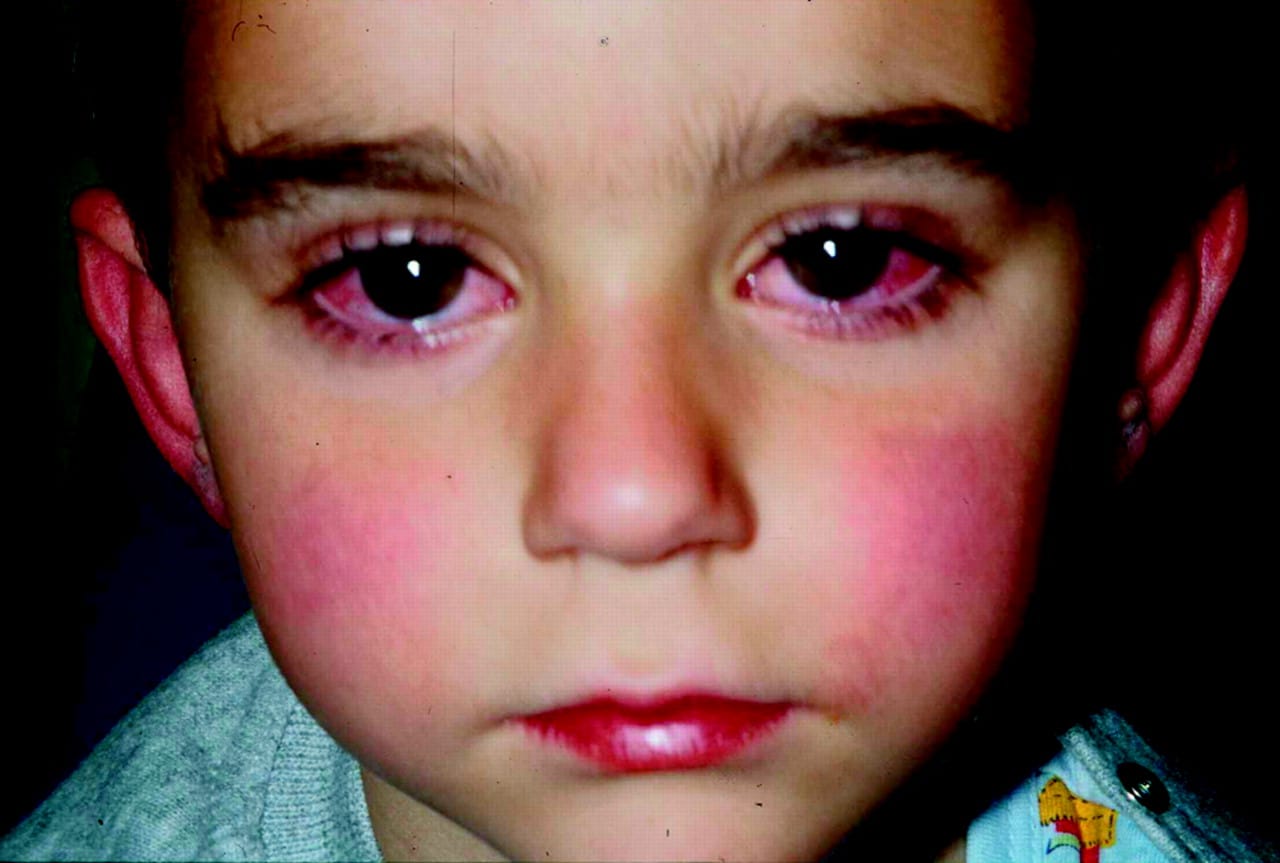 kawasaki-disease-causes-symptoms-and-treatment