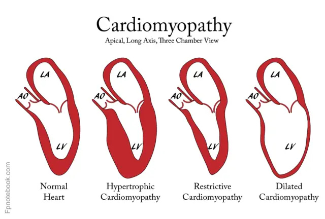 Cardiomyopathy – Types, Symptoms, Diagnosis And Treatment | Healthtian