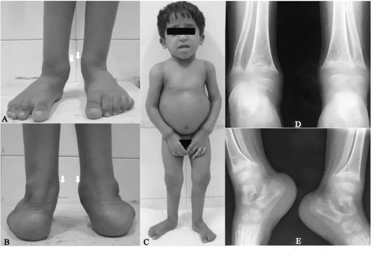 Rickets Symptoms Diagnosis Treatment And Prevention Healthtian