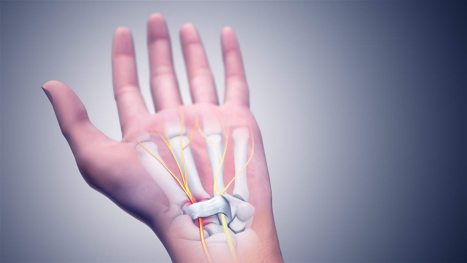 Carpal Tunnel Syndrome – Causes, Symptoms and Treatment | Healthtian