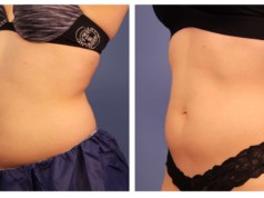 Coolsculpting