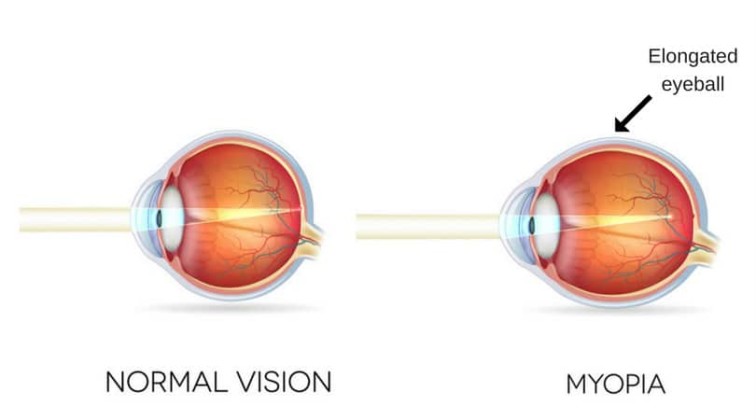 What is Myopia (Nearsightedness)? | Healthtian