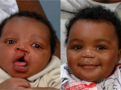 cleft palate and cleft lip