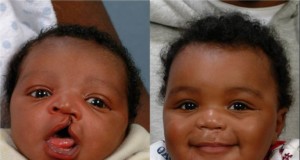 cleft palate and cleft lip