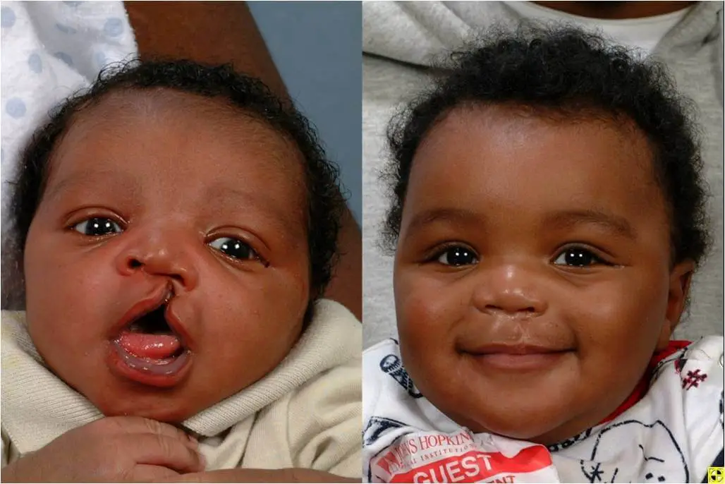 cleft-palate-and-cleft-lip-causes-symptoms-and-treatment