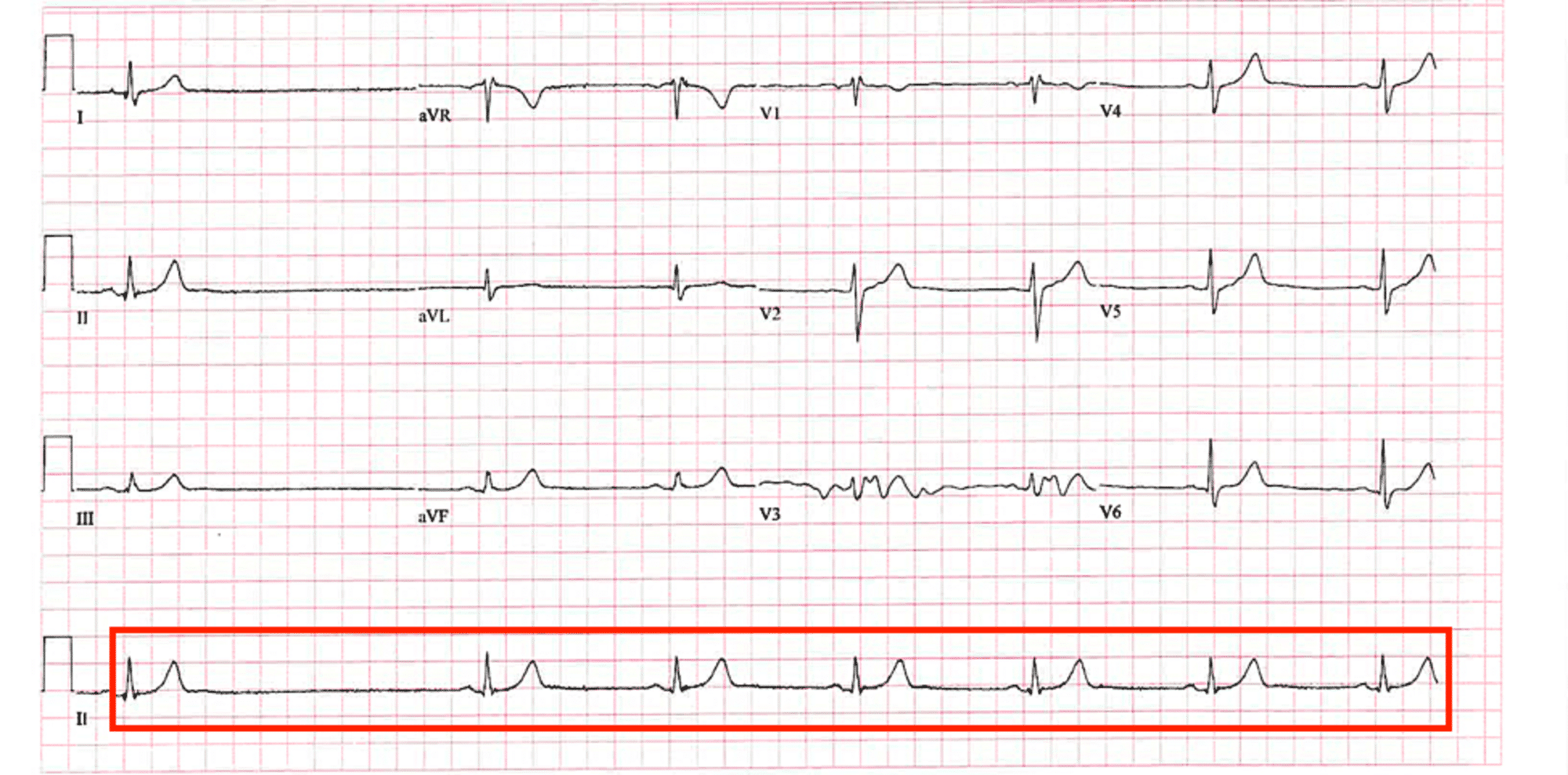 Bradycardia Slow Heart Rate Causes Symptoms And Prevention