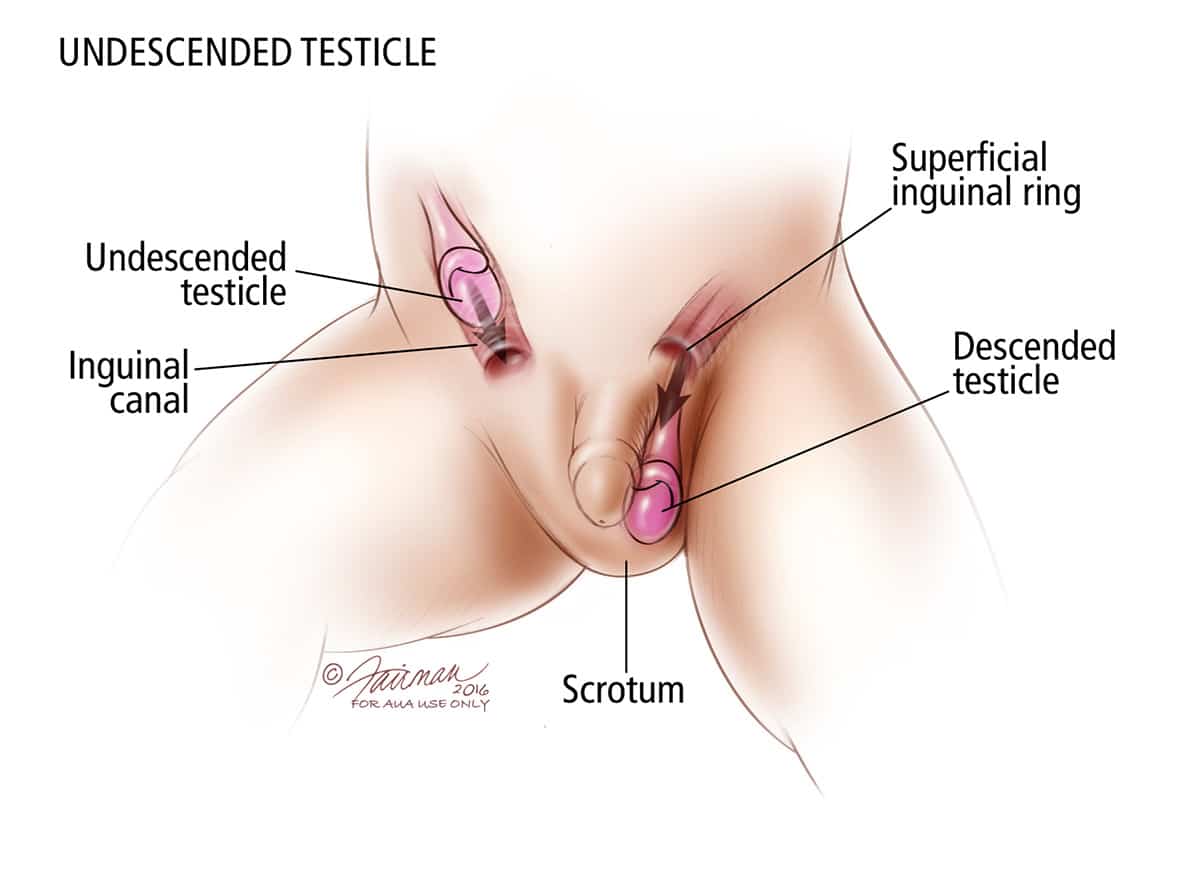 Cryptorchidism Undescended Testicles