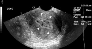 Hysterosonography Ultrasound (Sonohysterography)